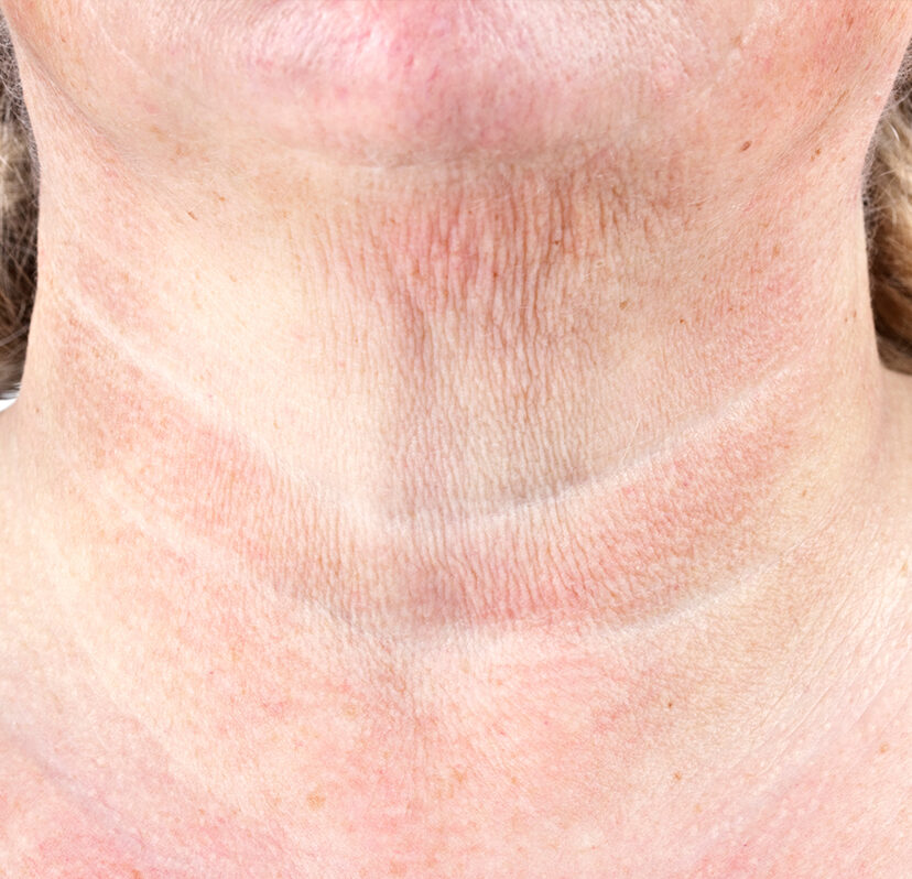 Photo of a crepey skin on a woman's neck