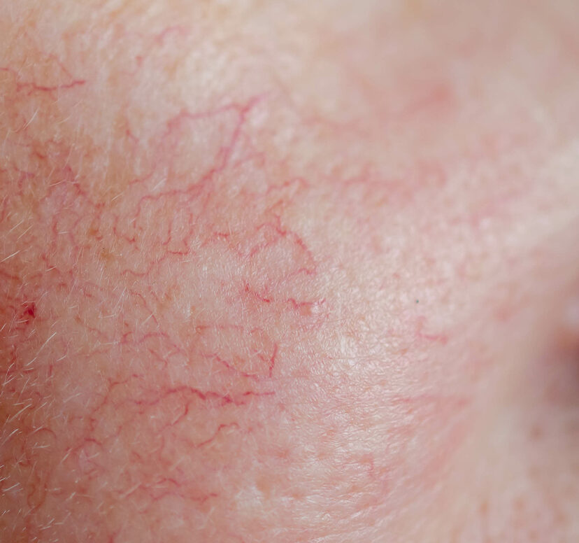 Close-up photo of facial veins