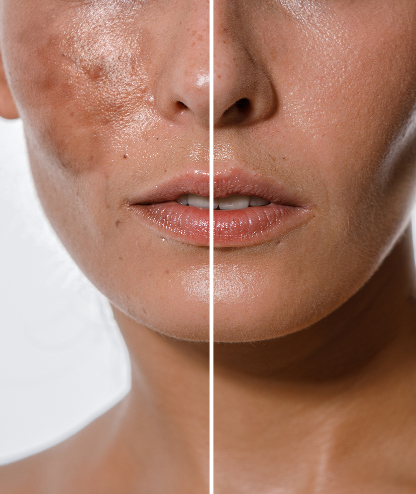 Before and after photos of a woman's face with hyperpigmentation