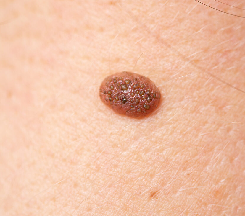 Photo of a pigmented skin lesion