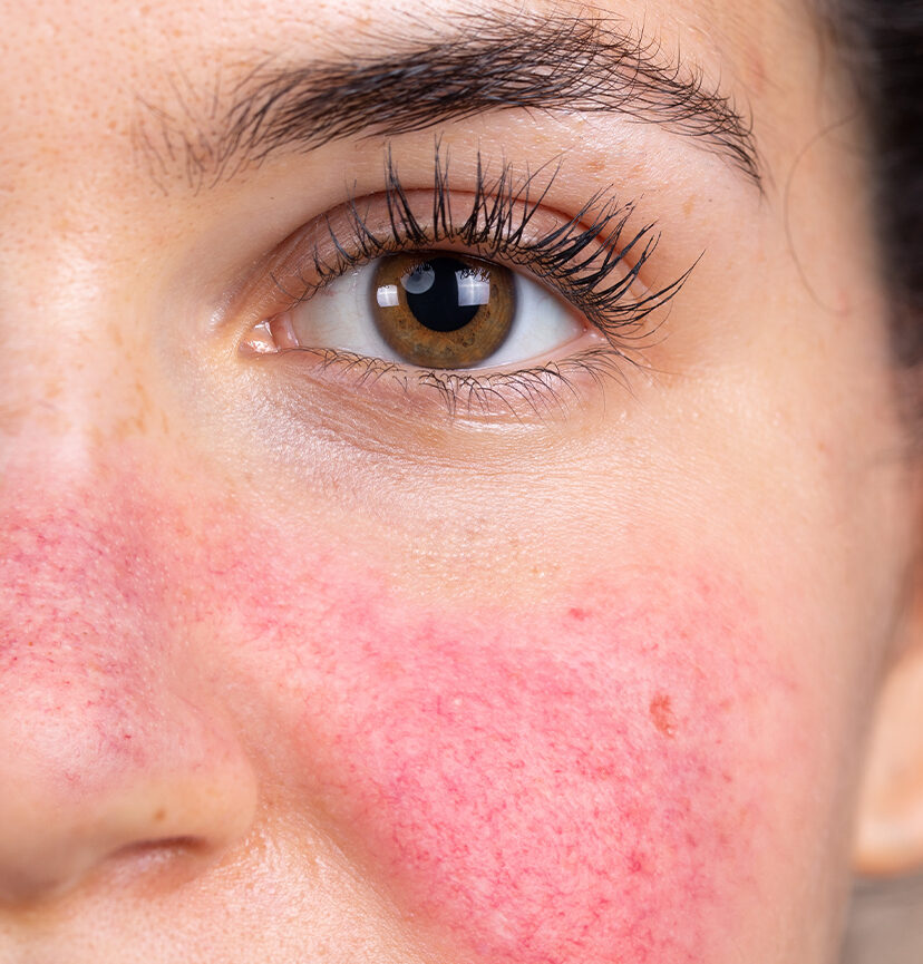 Photo of rosacea on a woman's cheek