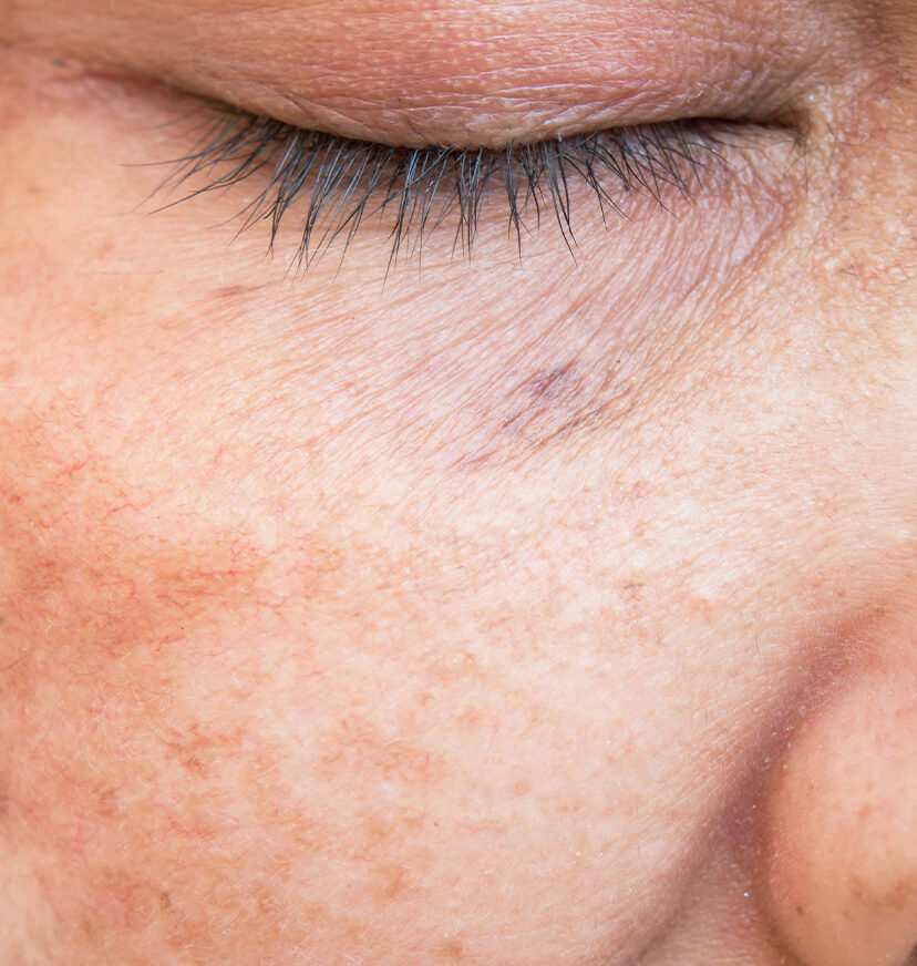 Photo of sun damage on a woman's cheek