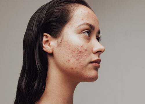 Photo of a woman with acne