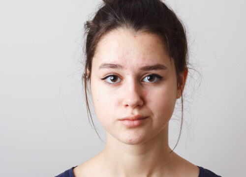 Photo of a young woman with dull skin