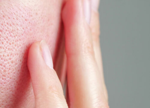 Photo of enlarged pores on a person's face
