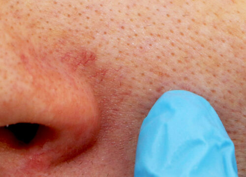 Photo of facial veins on a man's face