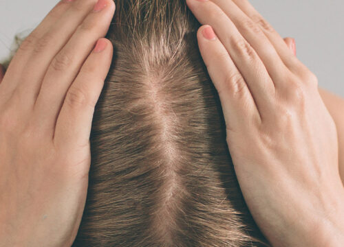 Photo of a woman's scalp with slight hair loss