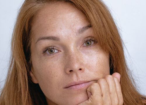 Photo of a woman with pigmented lesions on her face