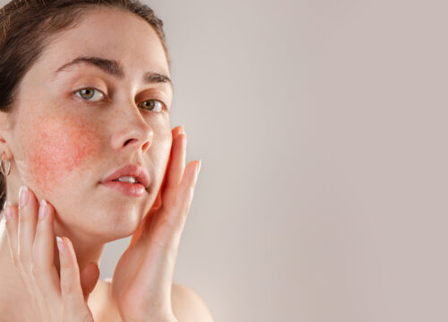 Photo of a woman with rosacea on her face