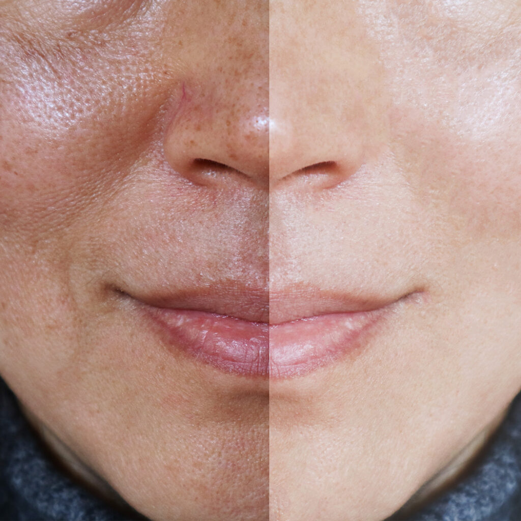 Before and after photos of a woman's face with melasma