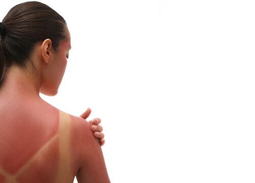 Photo of a woman with sunburn on her back and shoulders